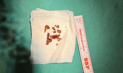 ESTETİK İÇİN GİTTİ, BURNUNDAN TAŞ ÇIKTI