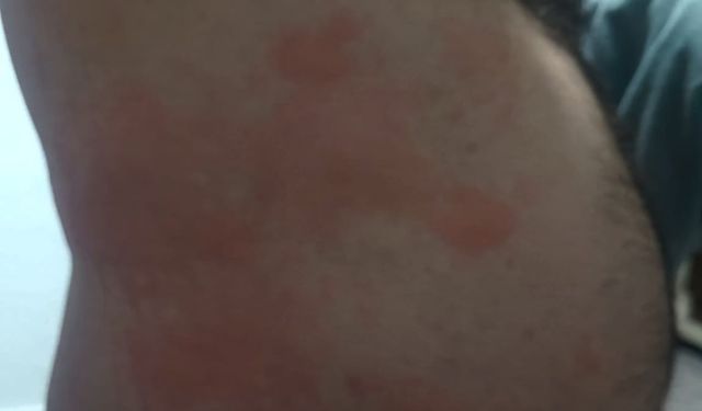 BÖCEK ISIRIĞI HASTANELİK ETTİ