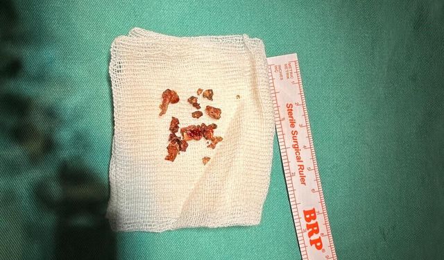 ESTETİK İÇİN GİTTİ, BURNUNDAN TAŞ ÇIKTI