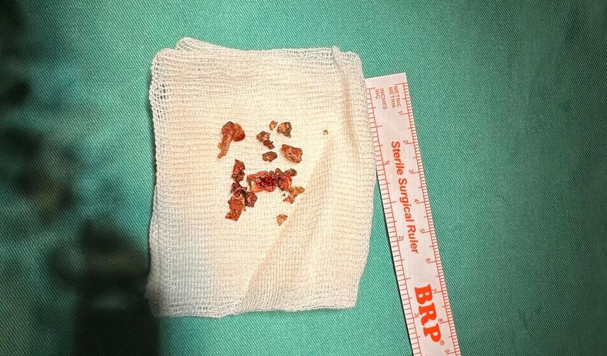 ESTETİK İÇİN GİTTİ, BURNUNDAN TAŞ ÇIKTI